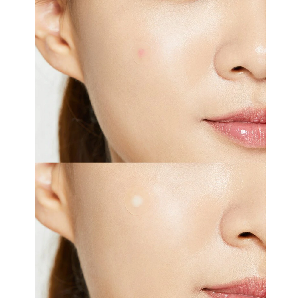 COSRXAcne Pimple Master Patches (24 Patches) - La Cosmetique